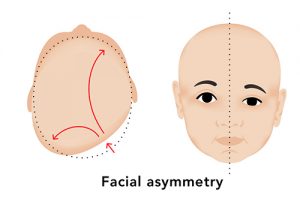 facial asimetri
